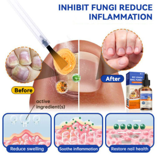 Bee Venom Nail Fungus Treatment Solution - Image 2